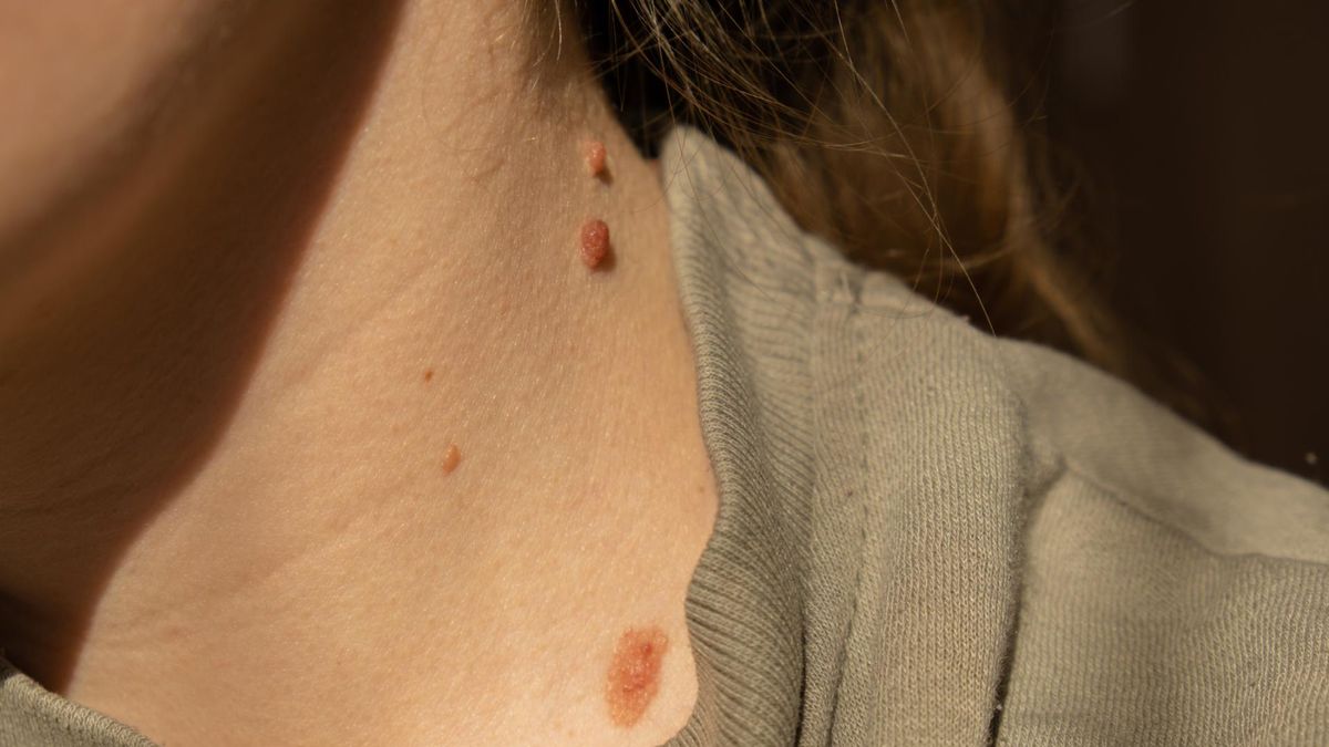 Najczęstszy pośród nowotworów skóry. To wcale nie czerniak