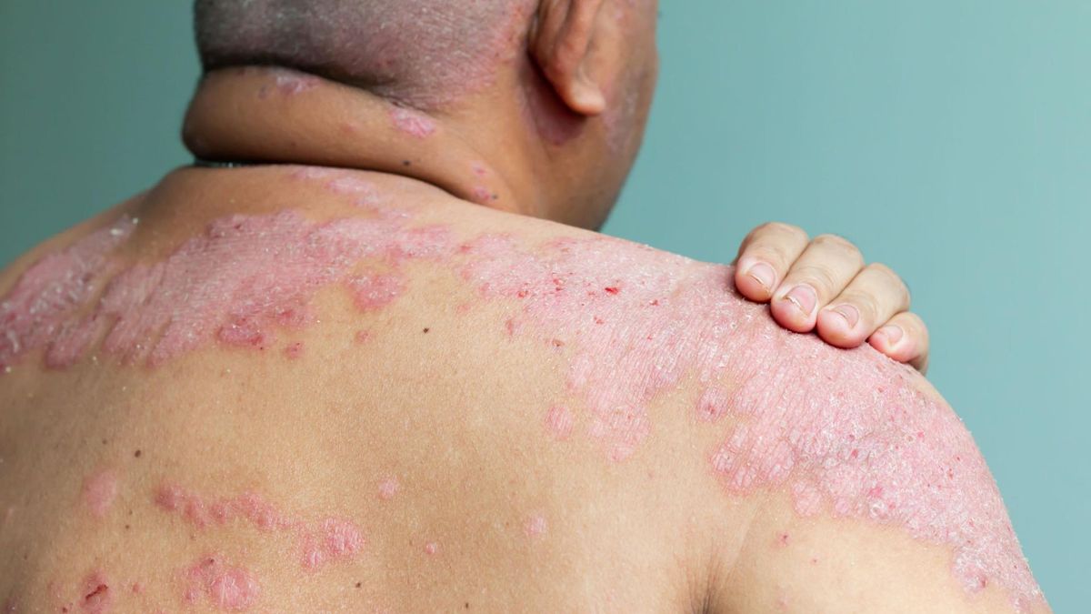 Erytrodermia łuszczycowa to łuszczyca skóry, której oznaki są widoczne na całej lub na znacznej większości powierzchni ciała.