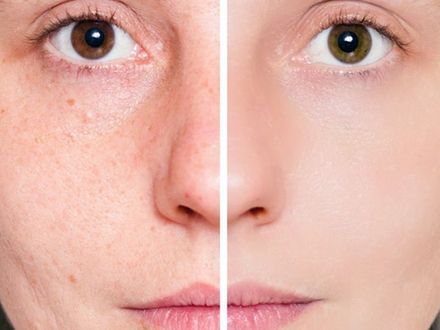 Jak pozbyć się blizn?