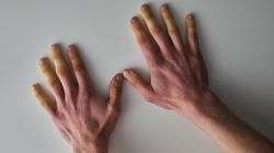 Zespół CREST - przyczyny, objawy, leczenie