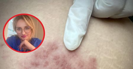 Pierwszy objaw choroby widać na twarzy. Ostrzega, że ważny narząd nie daje rady