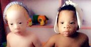 Bliźniaki o różnym kolorze skóry. Niezwykle zjawisko w Nigerii