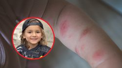 Rodzice sądzili, że ich dziecko ugryzł owad. Diagnoza była dużo gorsza