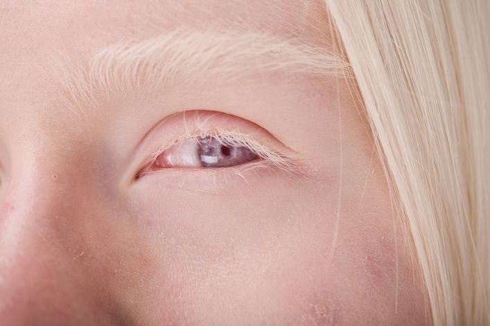 Albinizm oczny to choroba uwarunkowana genetycznie.