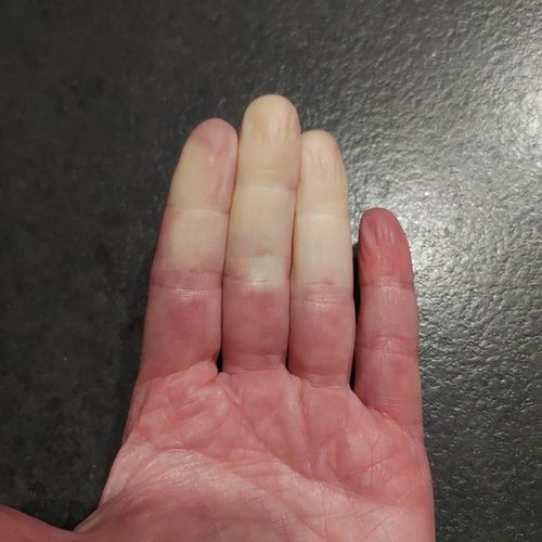 Tak wygląda dłoń żużlowca z chorobą Reynauda. Palce stają się białe pod wpływem niskich temperatur