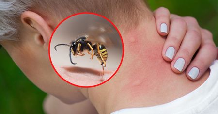 Skuteczne sposoby na użądlenie osy. Ból zniknie w kilka sekund