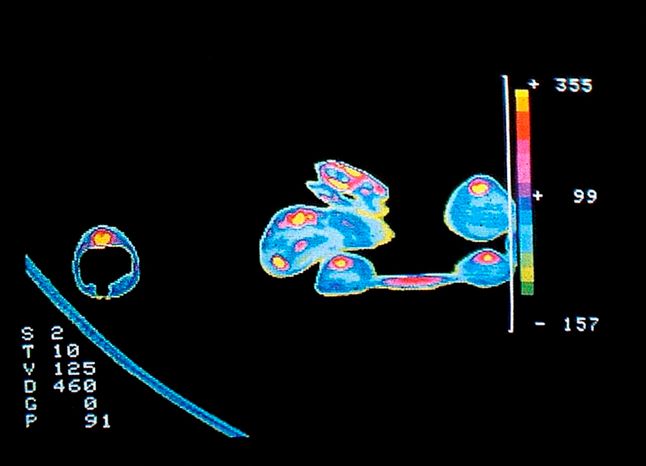 Przekrój węża trawiącego żabę w tomografii rentgenowskiej