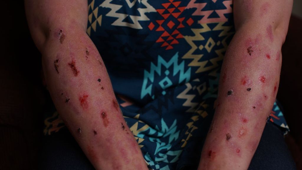 Belgia wprowadza obowiązkową kwarantannę dla osób zakażonych małpią ospą