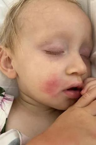 Pluskwy dotkliwie pogryzły dzieci