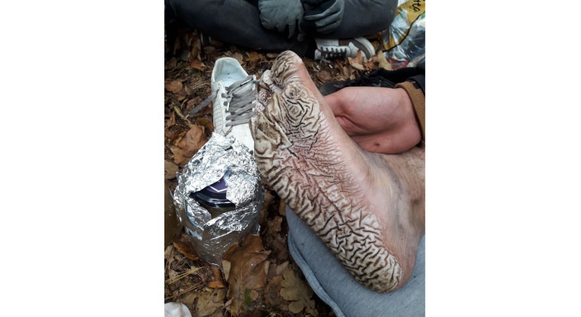Stopa jednego z migrantów po kilku dniach brodzenia na bagnach