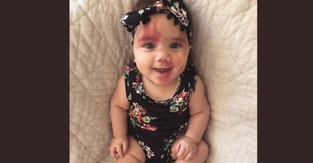 Urodziła się z "plamą wina porto". Mówili, że wygląda jak grillowana