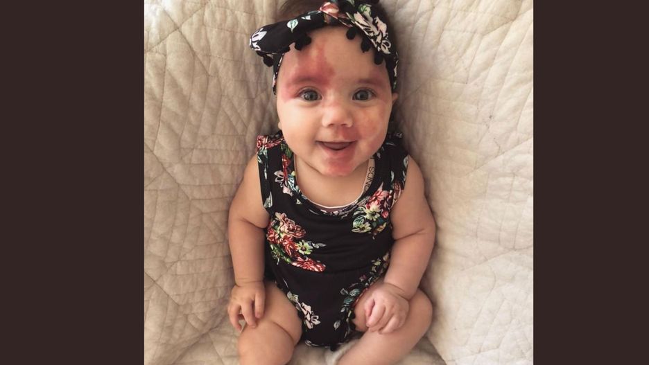 Urodziła się z "plamą wina porto" na twarzy. Mama dziewczynki walczy z hejtem w niecodzienny sposób