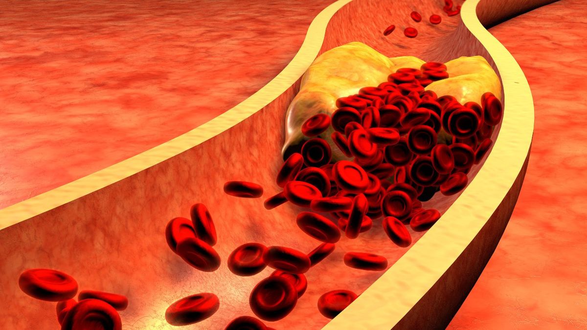 Ezetrol to lek, który stosuje się u pacjentów z wysokim poziomem cholesterolu i triglicerydów.