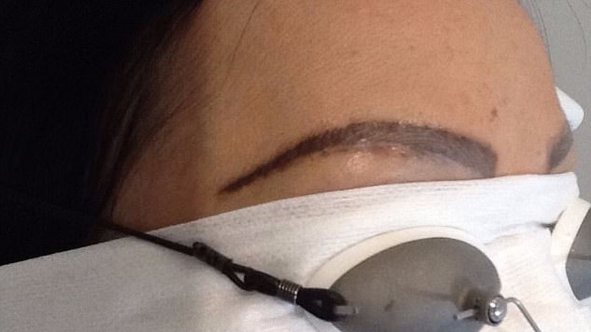 Nieudany zabieg laserowy