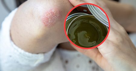 Koniec z problemami skórnymi. Ta maść z PRL-u działa cuda