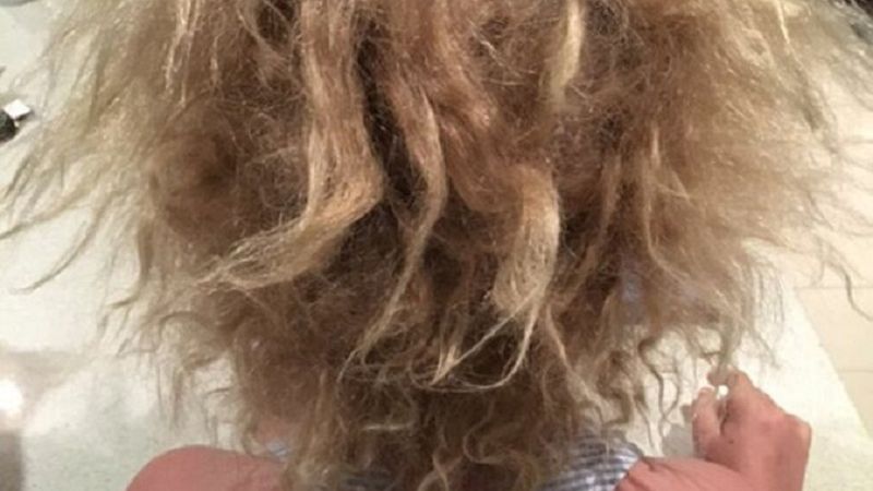 Shilah cierpi na zespół włosów niedających się uczesać