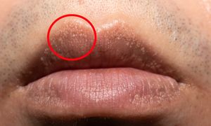Białe plamki na wargach? Nie zawsze to tylko problem kosmetyczny