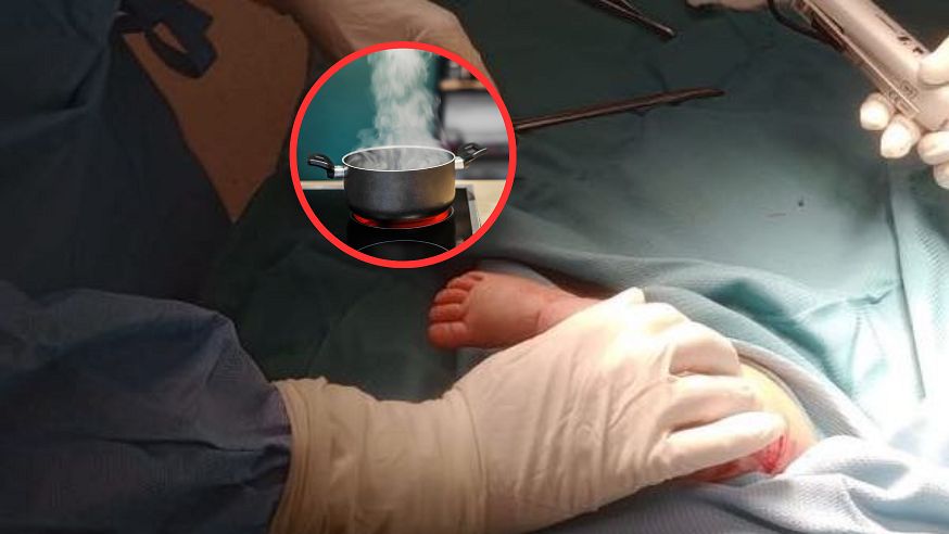 Na niemowlę wylał się wrzątek z termosu. Lekarze musieli działać szybko