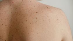 Rak skóry groźny latem. Jego symptomem jest… chropowata skóra