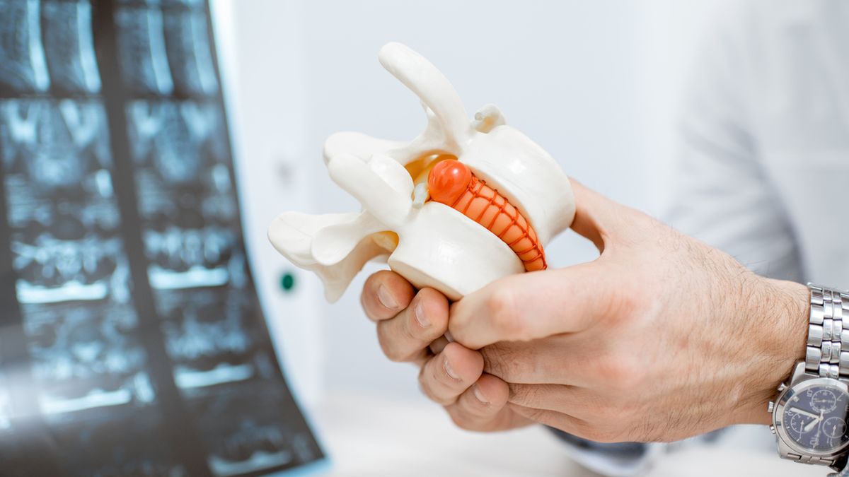 Wertebroplastyka wskazana jest także przy przepuklinie kręgosłupa