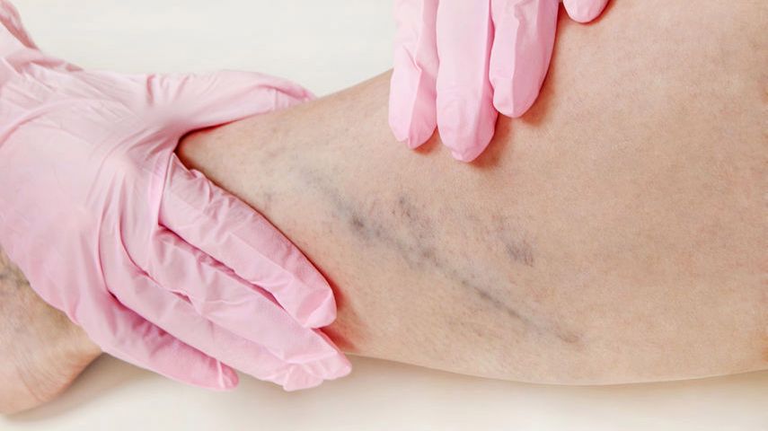 Objaw Homansa to ból w dole podkolanowym oraz w łydce, który pojawia się po wyprostowaniu nogi i zgięciu stopy w kierunku jej grzbietu