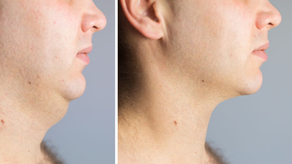 Przyczyną drugiego podbródka może być wada postawy.