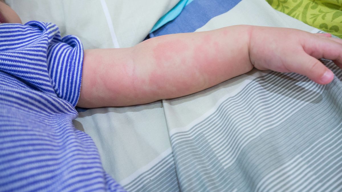 Świerzb u niemowląt może powodować zmiany skórne, takie jak grudki i czerwone krostki