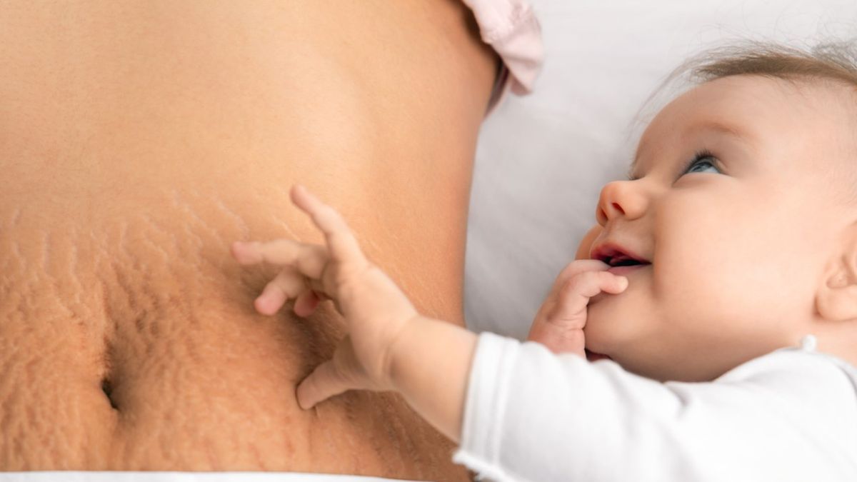 Rozstępy to wrzecionowate zmiany skórne o charakterze blizny.