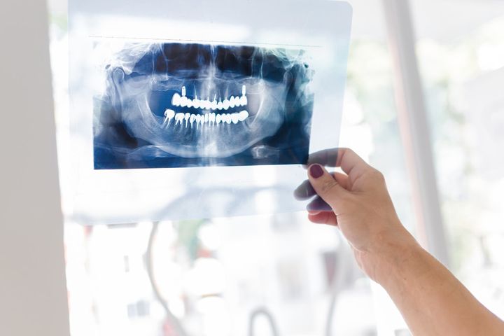 Zdjęcie pantomograficzne zębów to stomatologiczne zdjęcie RTG obrazujące zęby szczęki i żuchwy oraz otaczające je tkanki miękkie i kości.