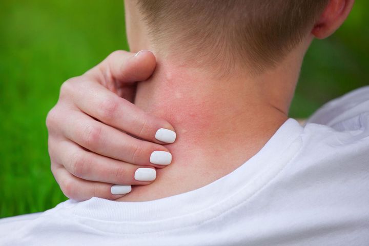 Ugryzienie strzyżaka sarniego może być bardzo bolesne