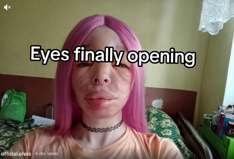 Elva po operacji