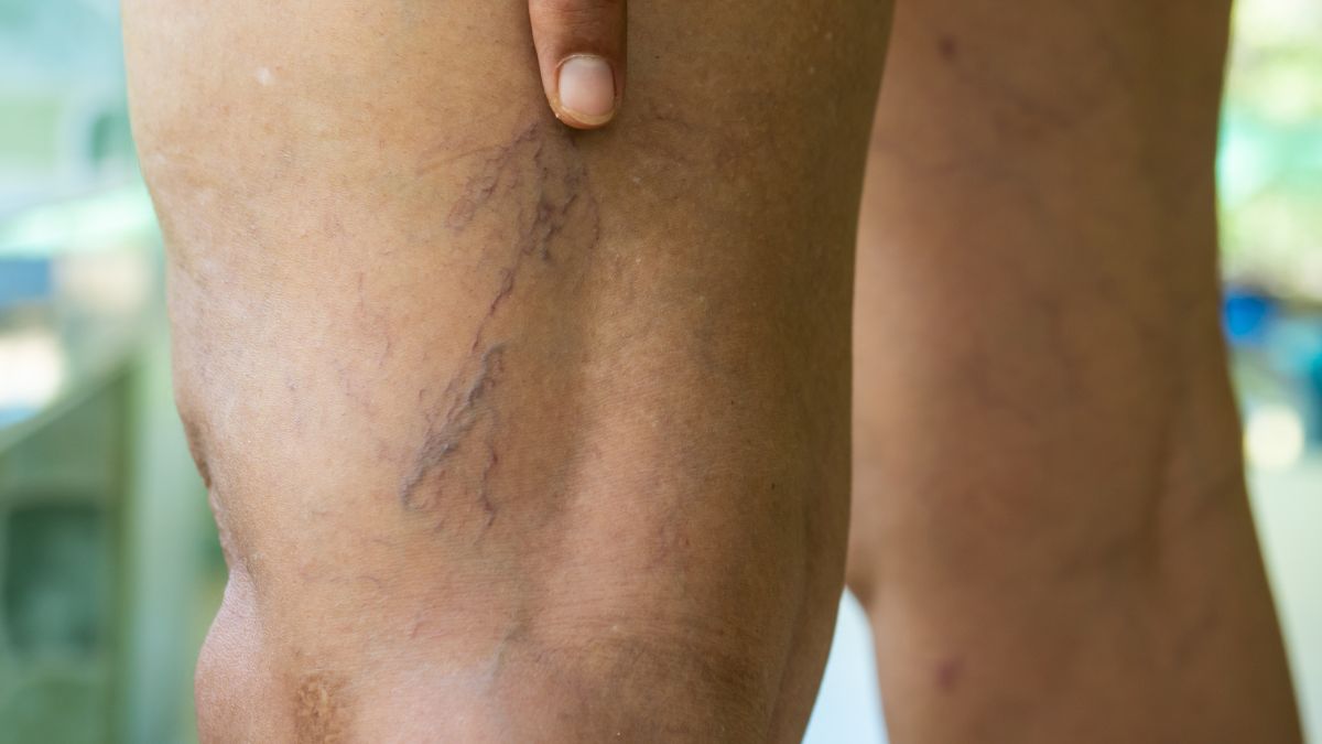 Jak usunąć pajączki?