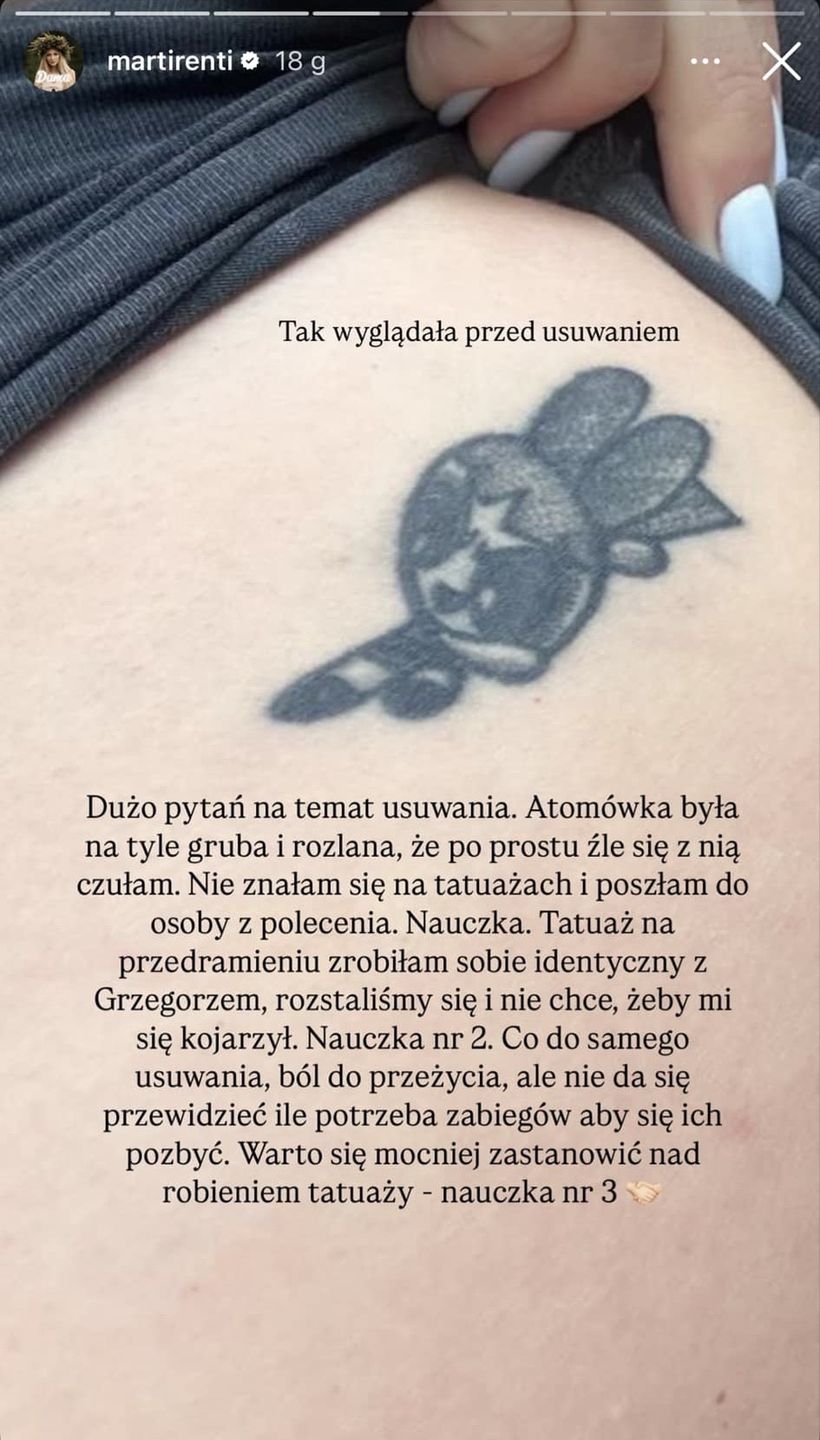 Martirenti usuwa tatuaże 