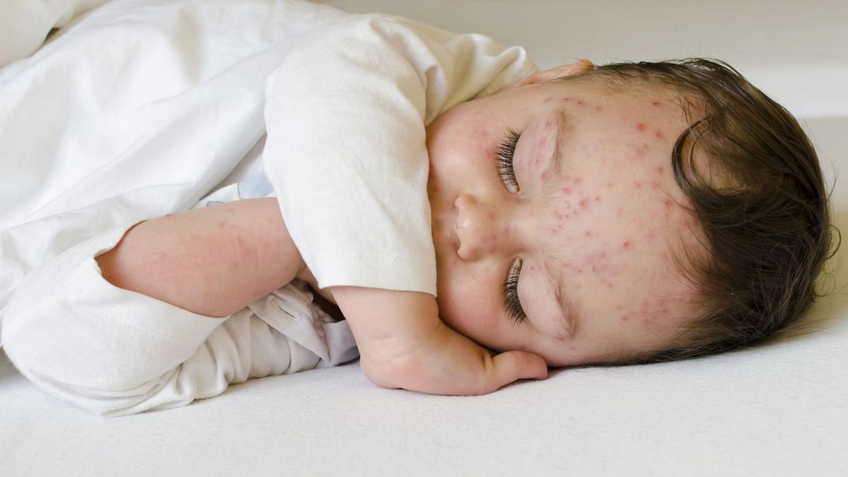 Ospa wietrzna jest chorobą zakaźną wywoływaną przez wirus Varicella Zoster Virus