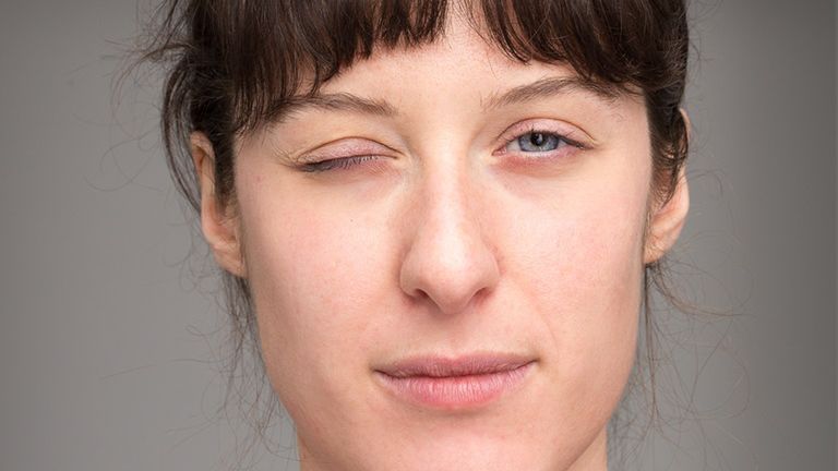 Jednym z objawów porażenia nerwu twarzowego jest trudność z zamknięciem powieki