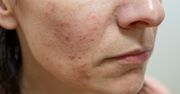 Kosztuje kilka złotych. W mig pomoże uporać się z trądzikiem