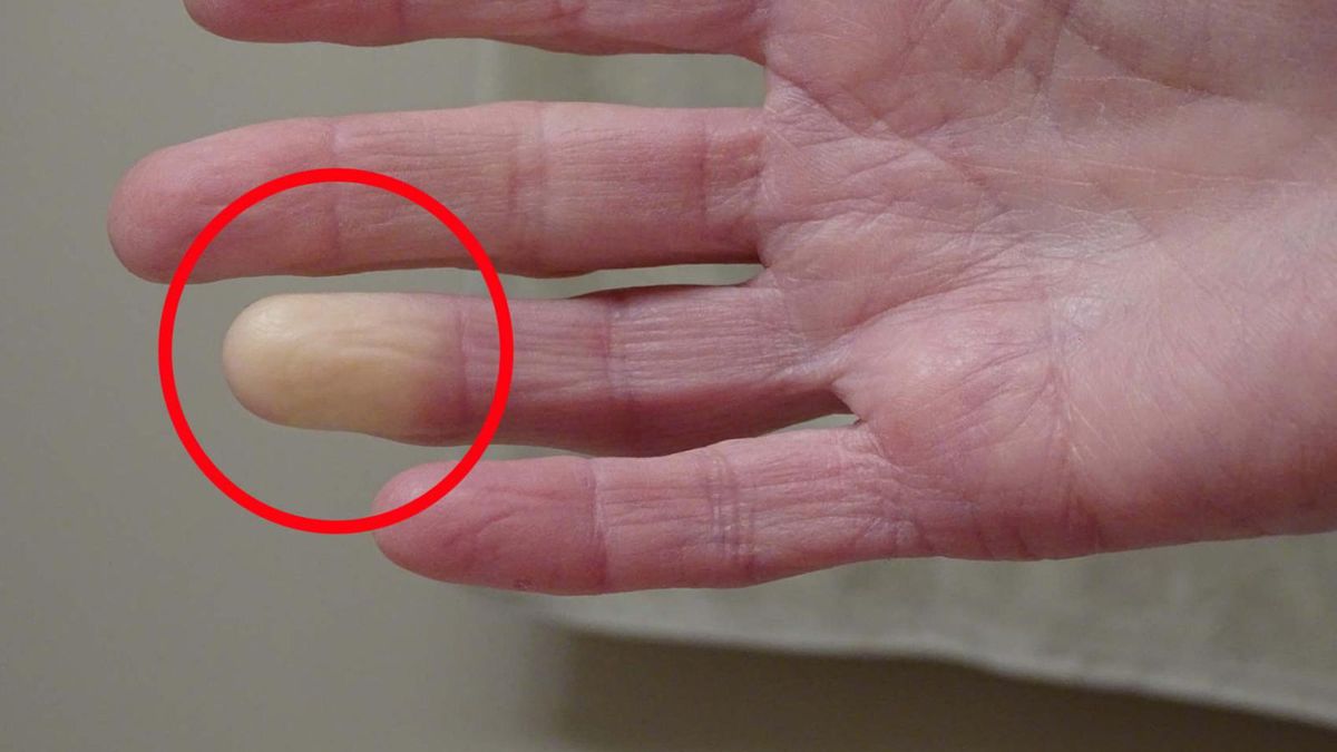 Zauważyłeś na dłoniach? "Może być także objawem paranowotworowym"