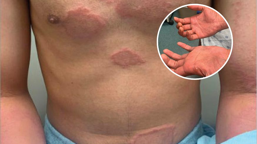 Tajemnicza wysypka na ciele młodego mężczyzny okazała się być objawem trądu