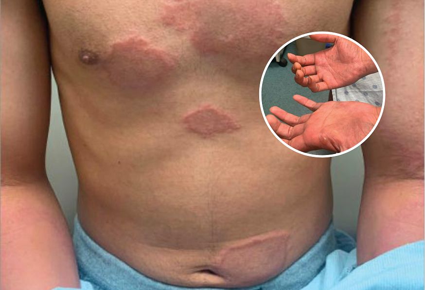 Dostał charakterystycznej wysypki. Diagnoza była szokiem