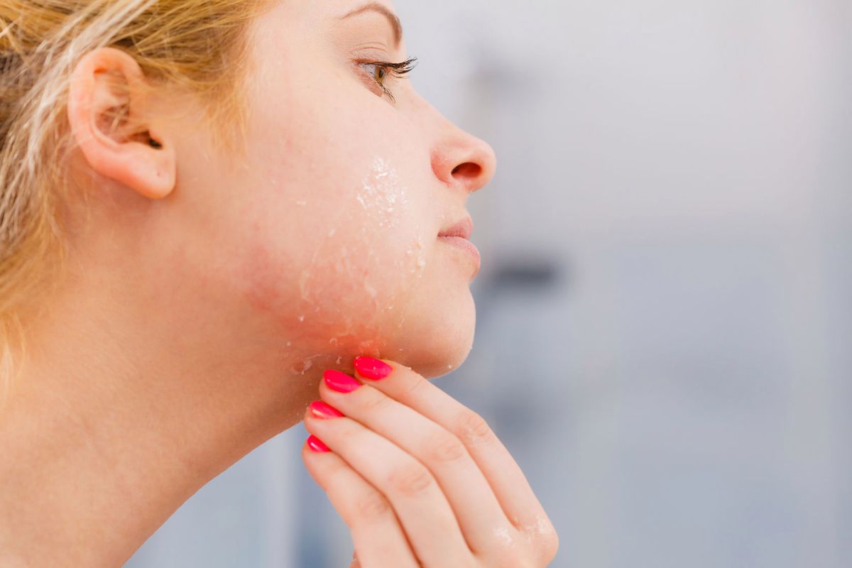Łuszcząca się skóra – o jakich chorobach może świadczyć?