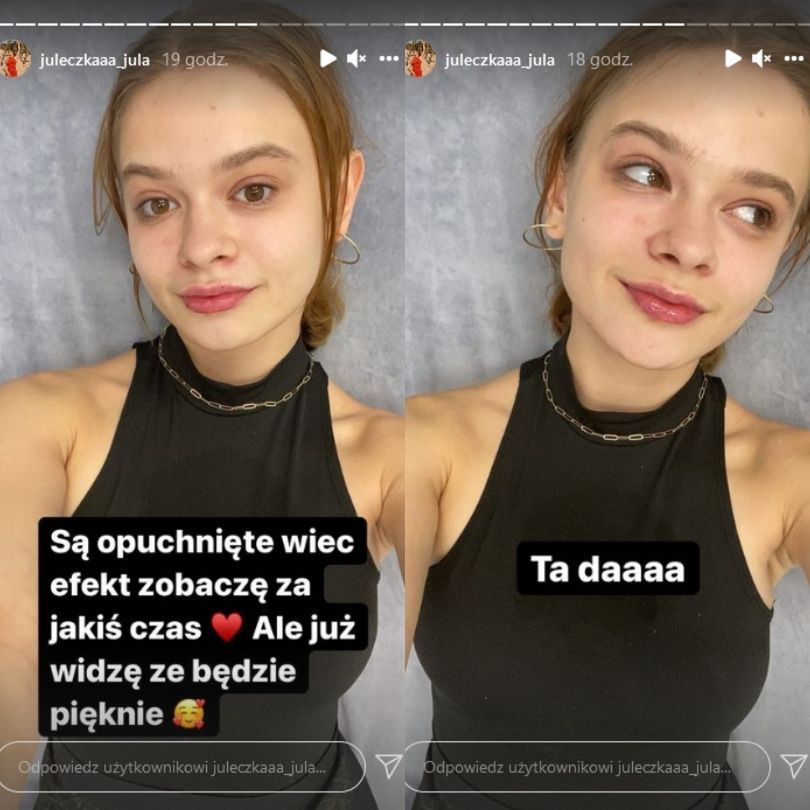 Julia Wróblewska powiększyła usta kwasem hialuronowym