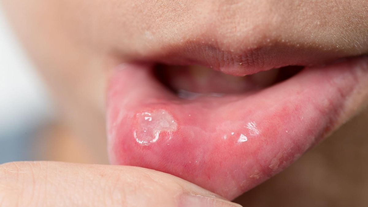 Pleśniawki najczęściej pojawiają się u niemowląt. 