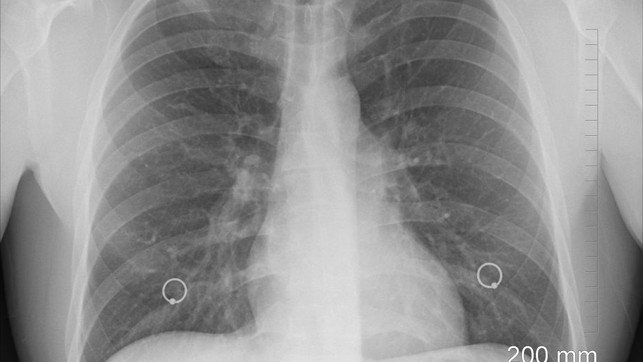 USG płuc pozwoli poprawnie zdiagnozować COVID-19