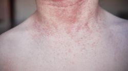 Zaczyna się wysypką. Kończy udarem lub zawałem