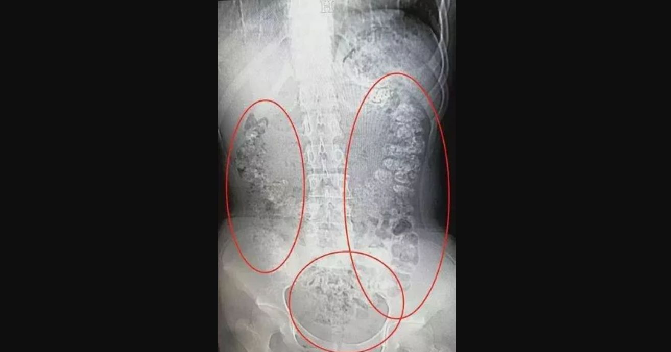 Bubble tea może być niebezpieczna dla jelit