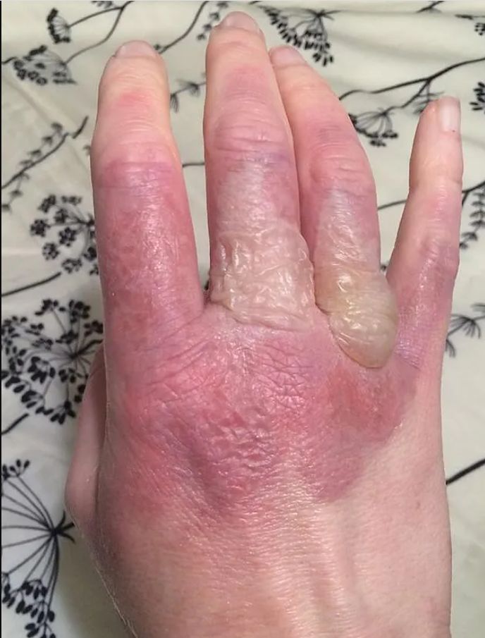 Obudziła się z poparzoną ręką po kontakcie z sokiem z limonki