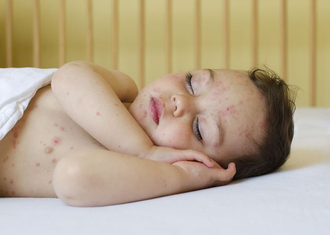 Pięć dziecięcych chorób, na które mogą cierpieć także dorośli