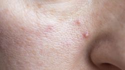 Kwasy tłuszczowe omega-3. To może być jedna z przyczyn trądziku