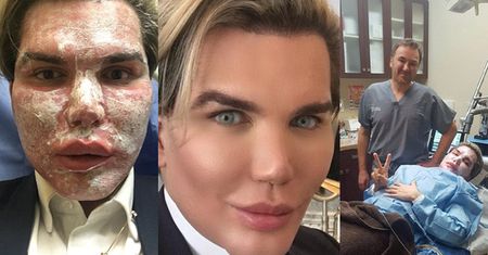 Brytyjski "Żywy Ken" pobił rekord świata! Zrobił sobie 51. operację plastyczną…