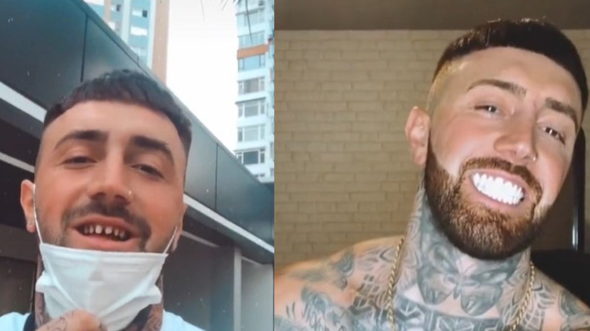 Zrobił sobie "tureckie zęby". Ludzie mówią, że wygląda jak koń